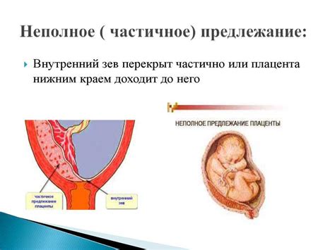 Симптомы и диагностика опущения плаценты