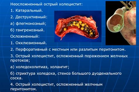 Симптомы и диагностика патологии холецистита