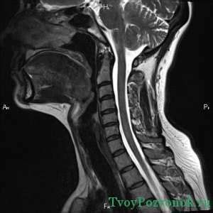 Симптомы и диагностика спондилоартроза шейного отдела