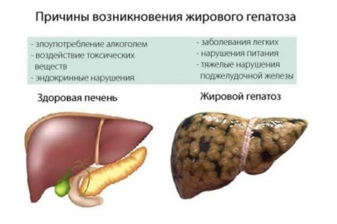 Симптомы и диагностика умеренного жирового гепатоза