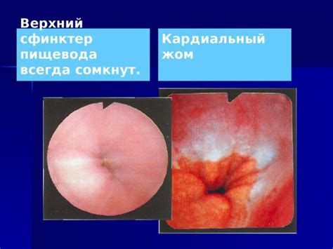 Симптомы и лечение недостаточности кардиального жома 2 степени