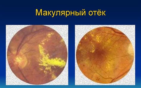 Симптомы и методы лечения отека верхних век