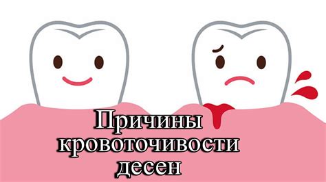 Симптомы и признаки, связанные с кровоточивостью