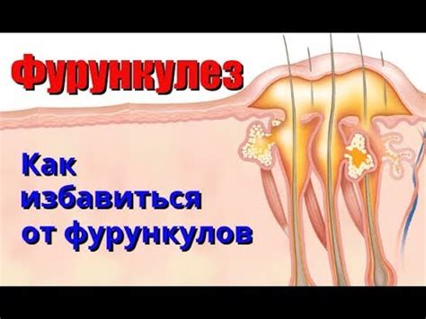 Симптомы и признаки внутренних фурункулов