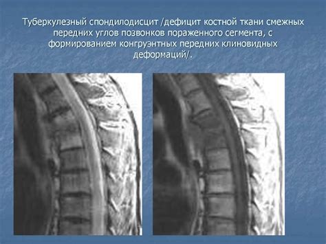 Симптомы и признаки скошенности передних углов позвонков