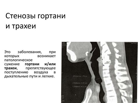 Симптомы и признаки стеноза