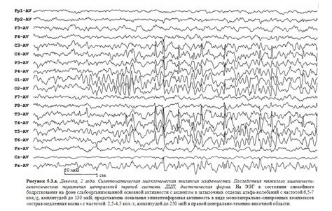 Симптомы и признаки фоновой ээг десинхронного типа