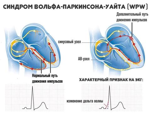 Симптомы и проявления синдрома WPW