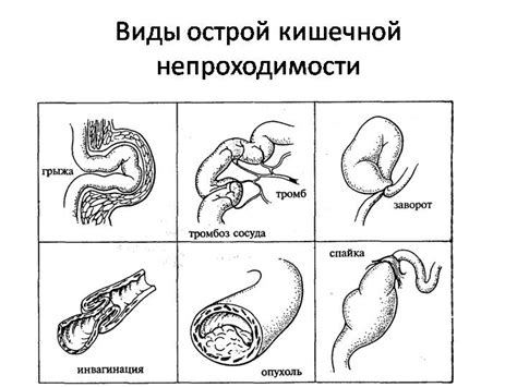 Симптомы кишечной непроходимости