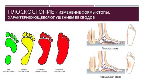 Симптомы комбинированного плоскостопия