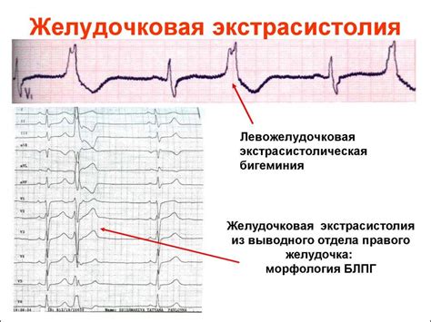 Симптомы наджелудочковых экстрасистол