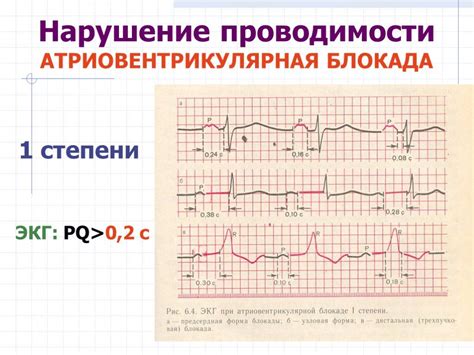 Симптомы нарушения метаболических процессов в миокарде