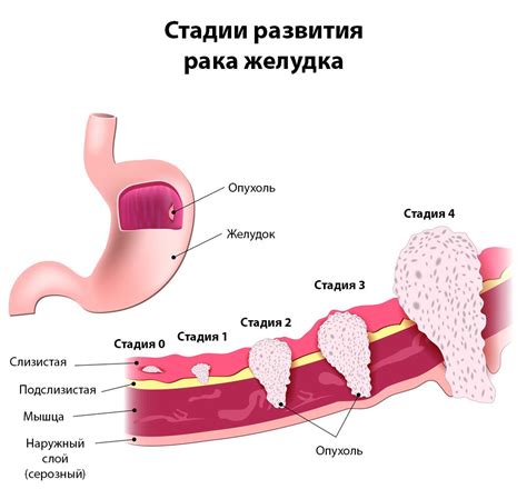 Симптомы нарушения нормацидности желудка