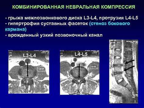 Симптомы невральной компрессии