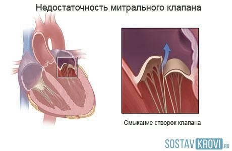 Симптомы недостаточности клапанов МПВ