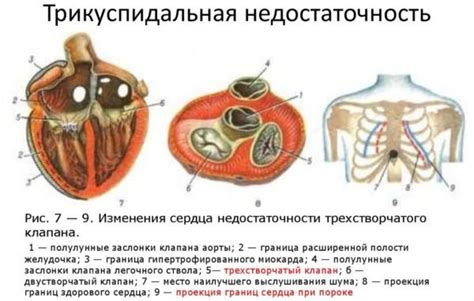 Симптомы недостаточности трикуспидального клапана 1 степени