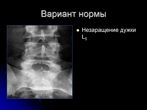 Симптомы незаращения задней дуги C1