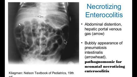 Симптомы некротизирующего энтероколита