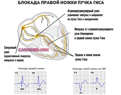 Симптомы неполной блокады левого пучка Гиса