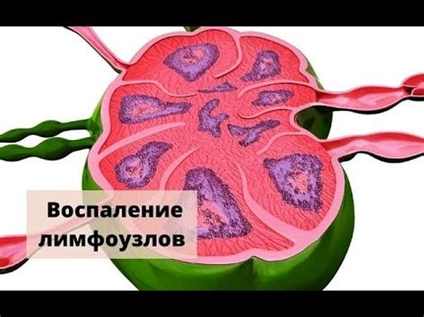 Симптомы обызвествления лимфоузлов и возможные осложнения