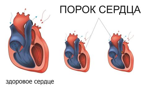 Симптомы опущенного сердца