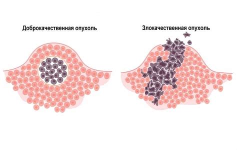 Симптомы остеомы лобной кости