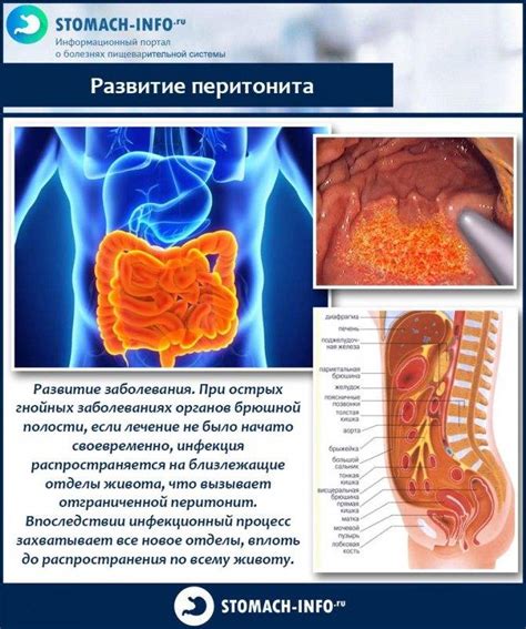 Симптомы острого перитонита