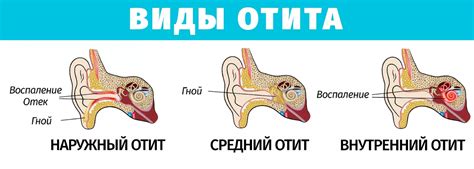 Симптомы отита ушей