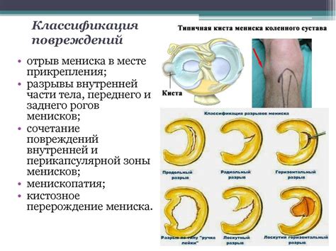 Симптомы оторванного мениска