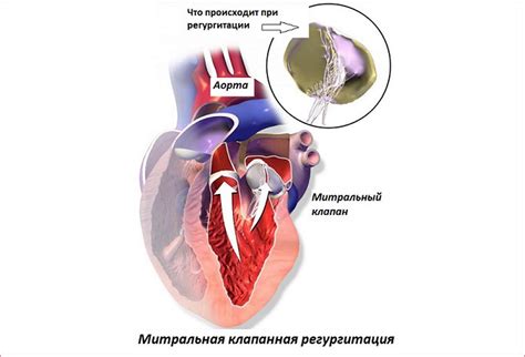 Симптомы патологической регургитации