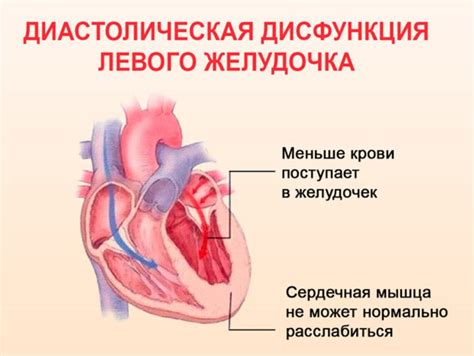 Симптомы перегрузки левого желудочка