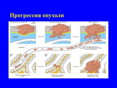 Симптомы периневрального роста опухоли