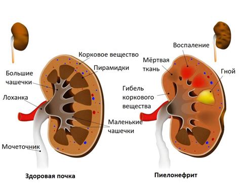 Симптомы пиелонефрита в ремиссии