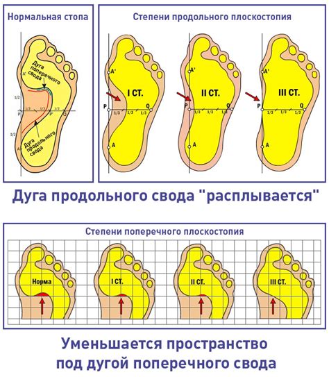 Симптомы плоскостопия у детей