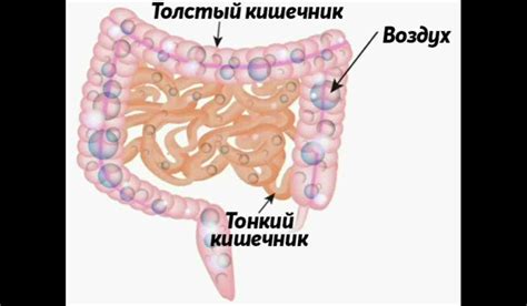 Симптомы повышенной пневматизации толстого кишечника