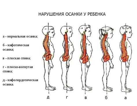 Симптомы поперечной осанки