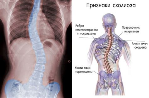 Симптомы правостороннего сколиоза грудного отдела позвоночника