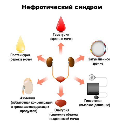 Симптомы пролиферативного гломерулонефрита