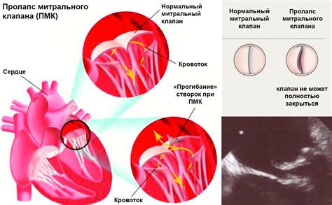 Симптомы пропуска клапана сердца