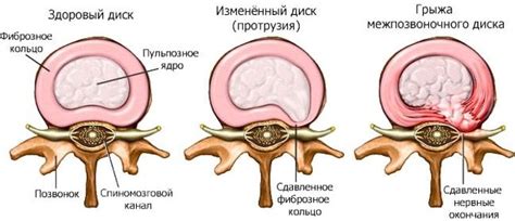 Симптомы протрузии межпозвоночных дисков