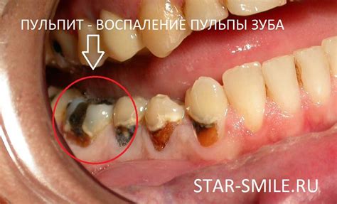 Симптомы пульсирующего зуба