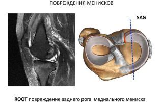 Симптомы разрыва медиального мениска