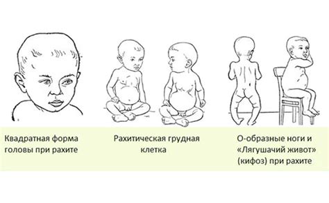 Симптомы рахита у ребенка