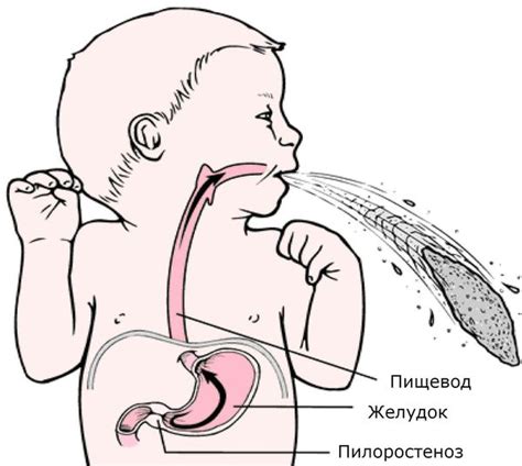 Симптомы рвоты фонтаном