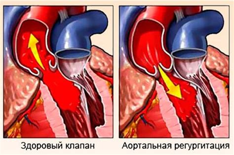 Симптомы регургитации аортального клапана и как их улучшить