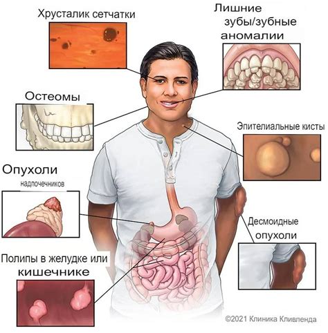 Симптомы синдрома Гарднера