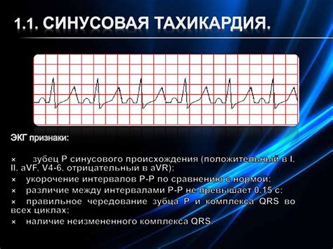 Симптомы синусовой тахикардии у детей