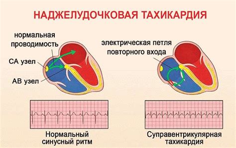 Симптомы синусовой тахикардии у мужчин