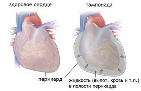 Симптомы тампонады сердца