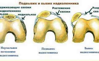 Симптомы травмы мениска